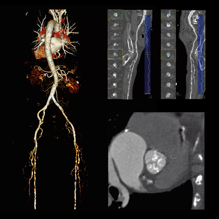 tomografia komputerowa angio-tk-aorty-tetnic-konczyn-bydgoszcz