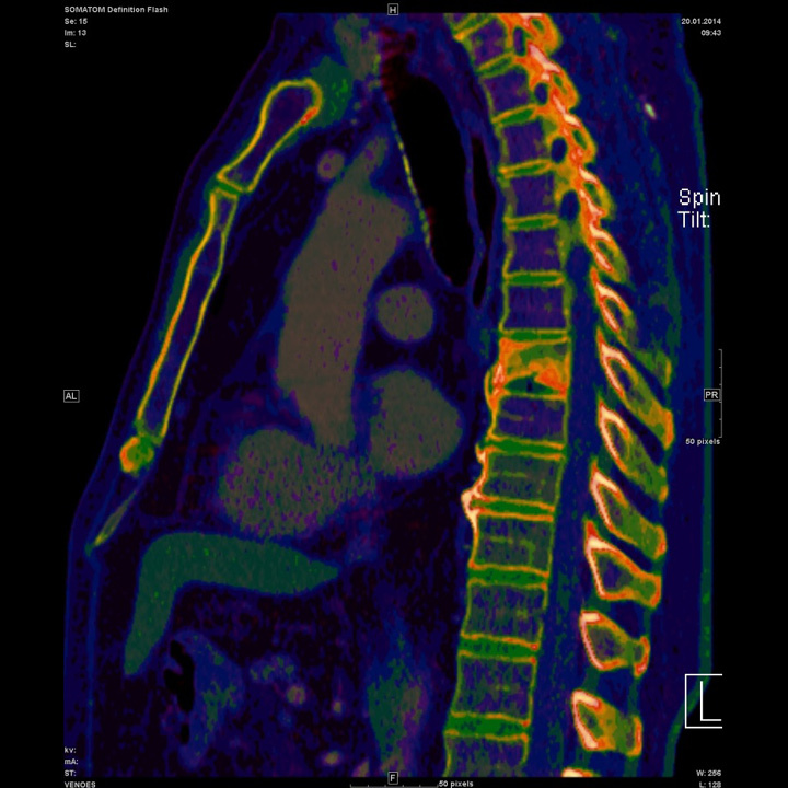 tomografia-komputerowa-płuc