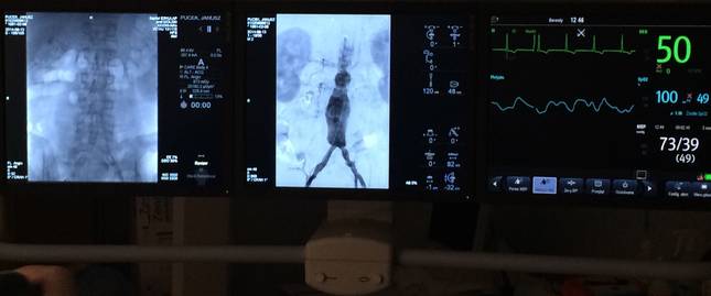 stentgraft, operacja tetniaka aorty brzusznej bydgoszcz osielsko